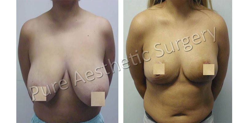 Female Breast Surgery 3