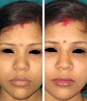 Nose shape surgery cost in india