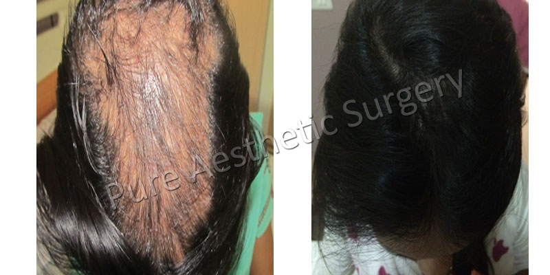 prp hair treatment in delhi