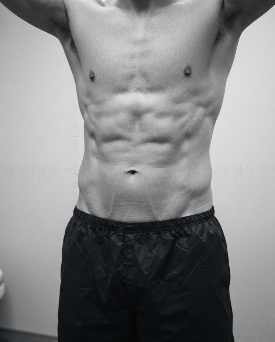 Male abdomen after high-definition VASER liposuction