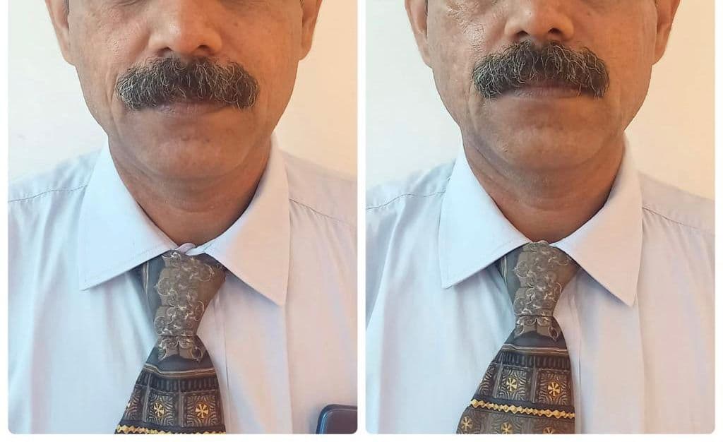 Thread lift patient before and after jawline contouring