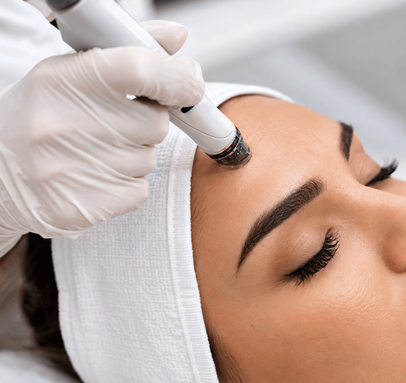 Microdermabrasion