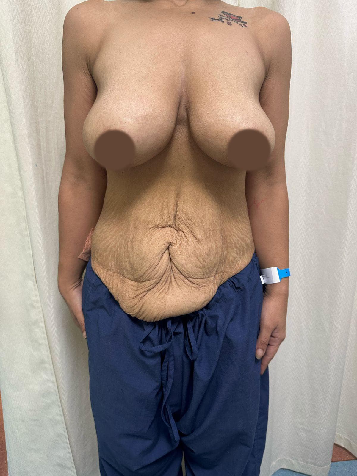 High-definition lipo-sculpture patient before treatment