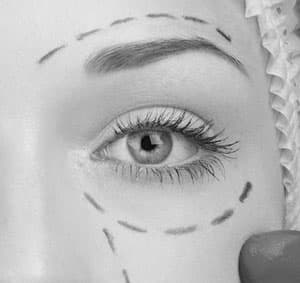 Surgical mapping marker lines on upper eyelid