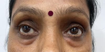 Eyelid surgery patient before treatment