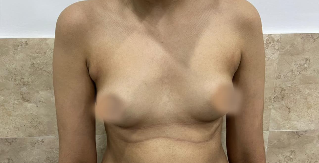 Breast surgery patient before treatment