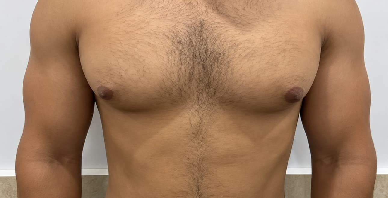 Gynecomastia patient before treatment