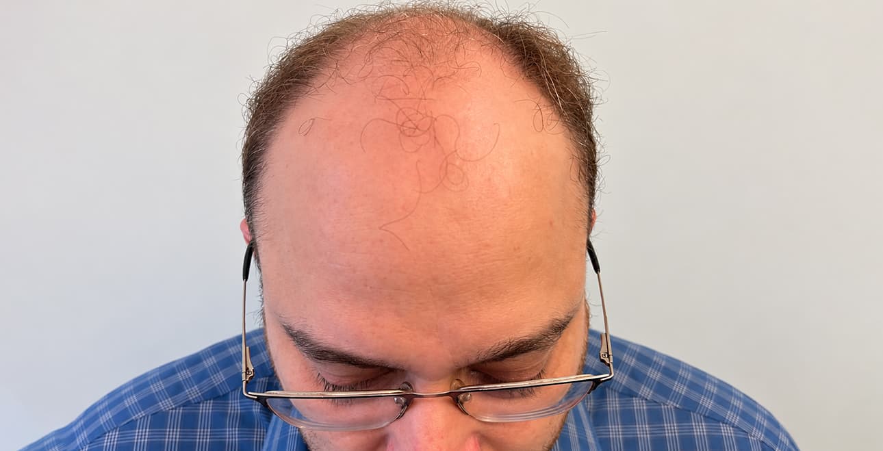 Hair transplant patient's thinning crown and hairline before treatment