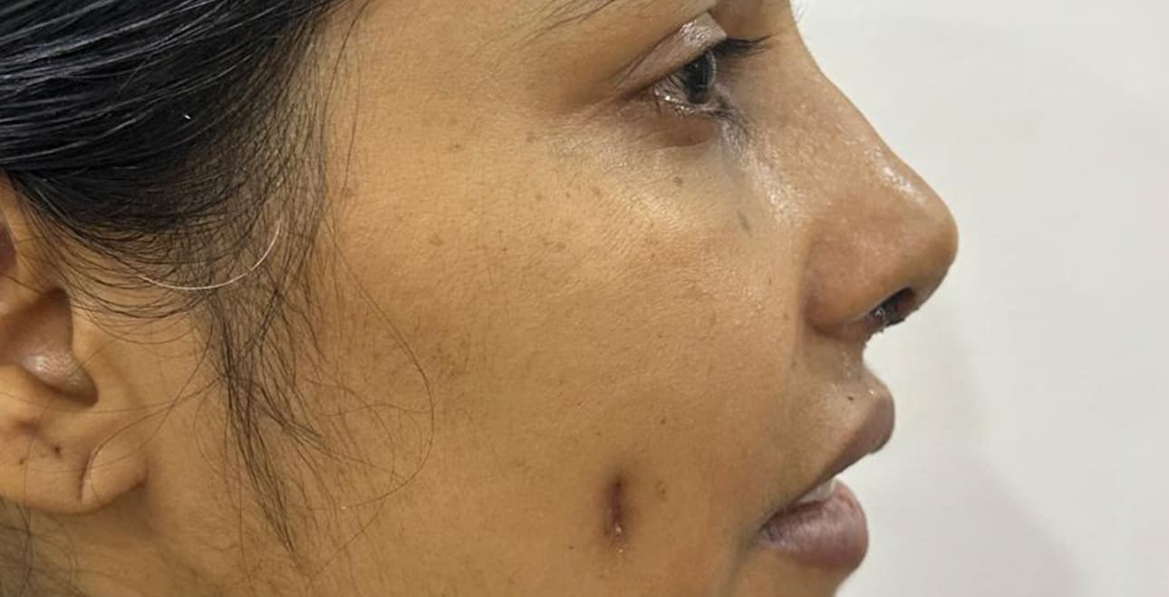 Rhinoplasty patient profile before surgery