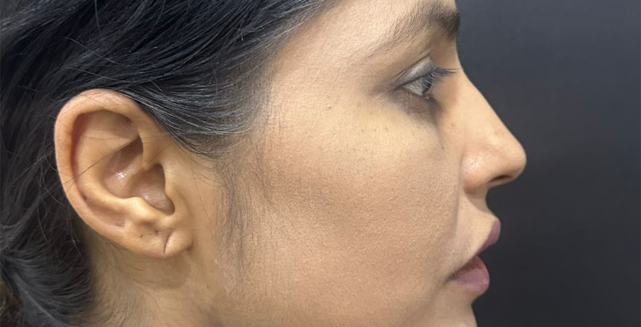 Rhinoplasty patient profile after surgery