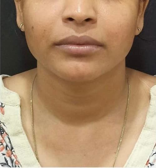 Thread lift patient before treatment