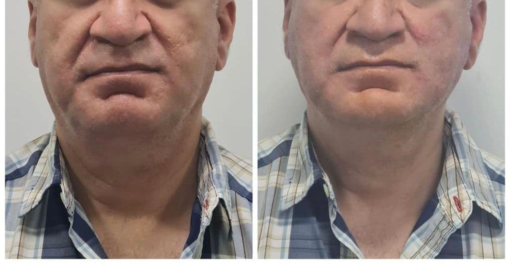Thread lift patient 2, before and after