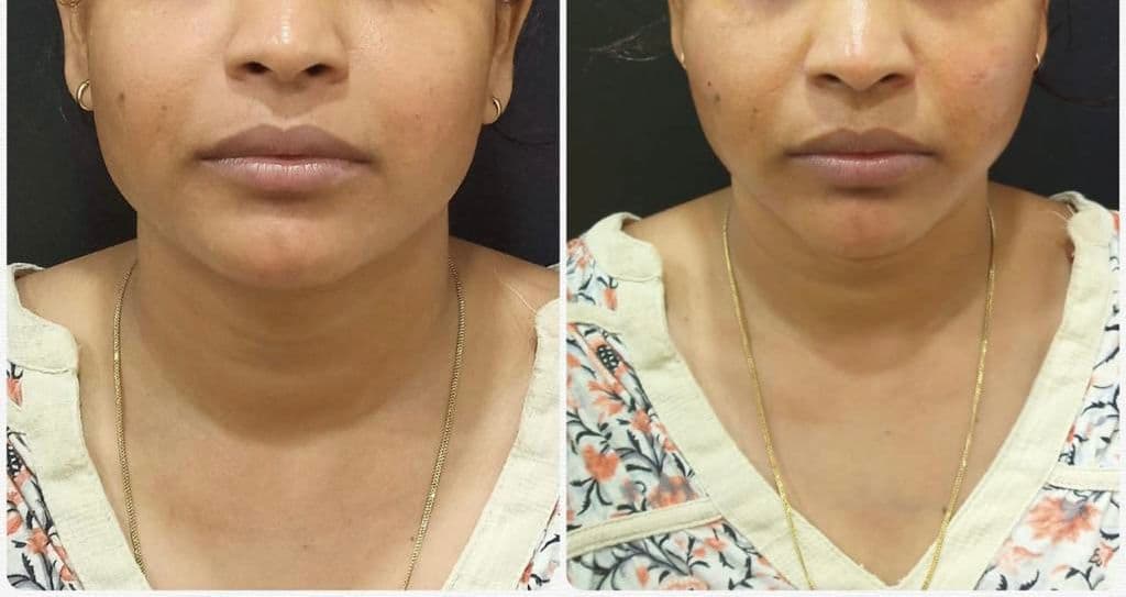 Thread lift patient 3, before and after
