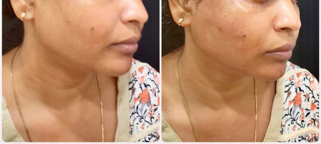 Thread lift patient 5, before and after