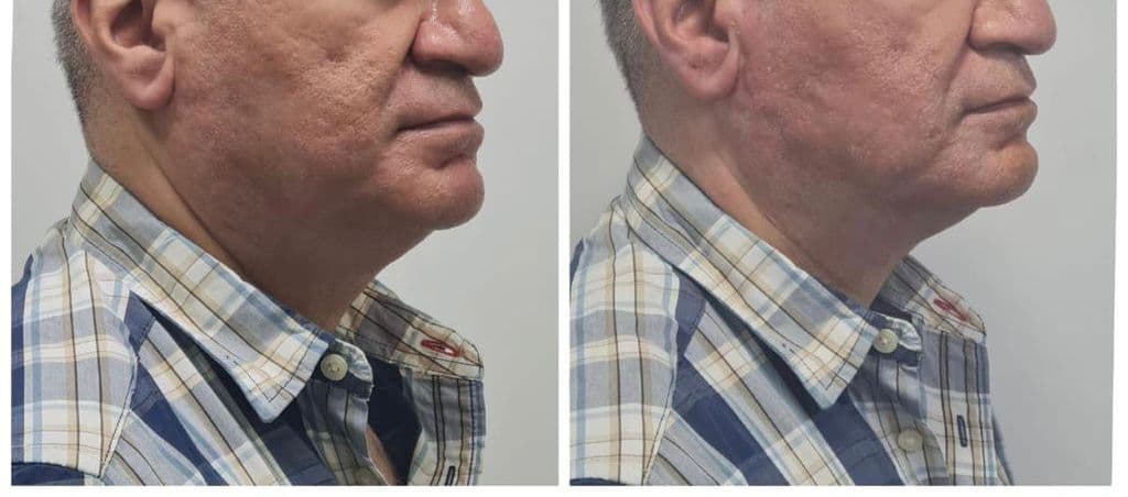 Thread lift patient 8, before and after