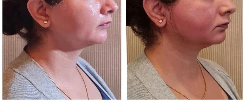 Thread lift patient 10, before and after