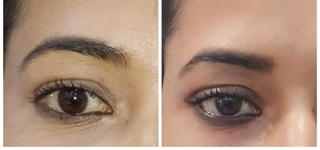 Thread lift patient 11, before and after