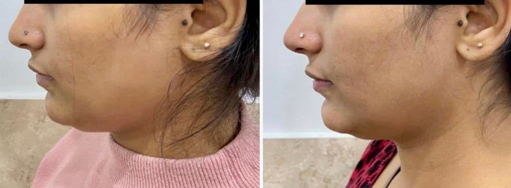 Thread lift patient 12, before and after