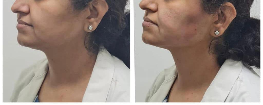 Thread lift patient 13, before and after