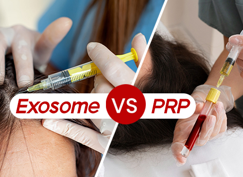 Exosome vs PRP Hair Loss Treatment: Which One is Right for You?