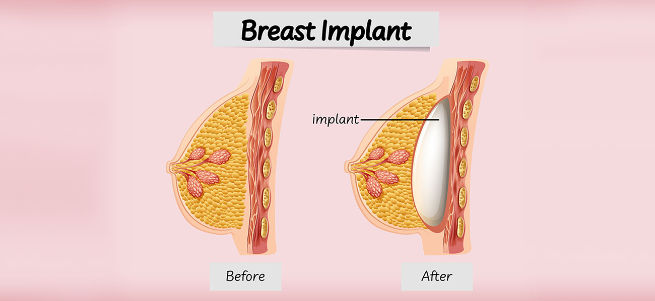 How much do breast implants cost in India?