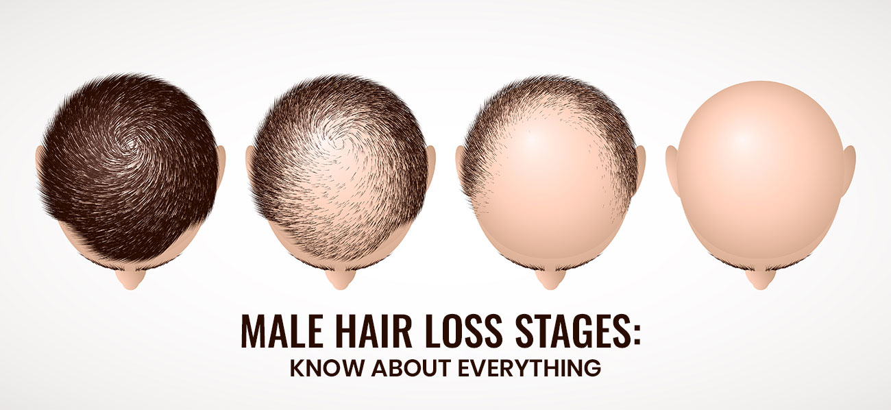 Male Hair Loss Stages: Know About Everything