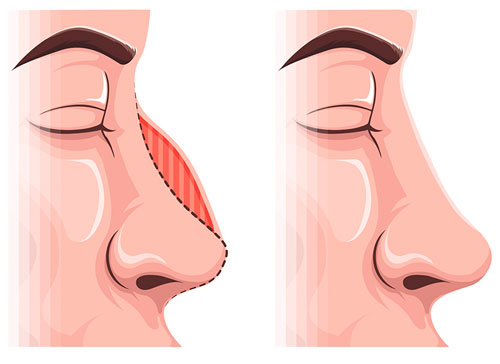 Rhinoplasty Cost in India – Complete Guide 2025