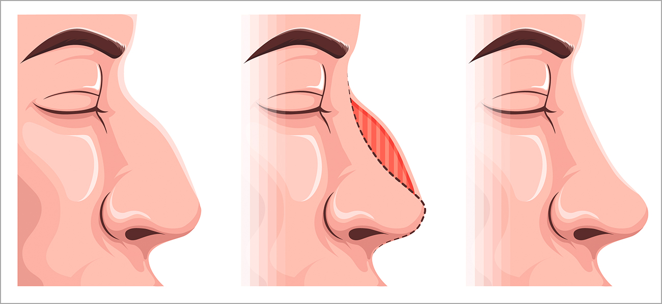 Rhinoplasty Cost in India – Complete Guide 2025
