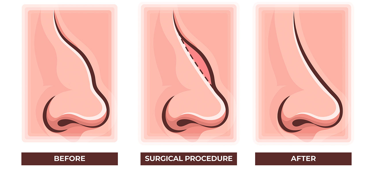 Nose Job Cost in Delhi: Affordable Rhinoplasty Cost in Delhi