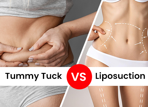 Tummy Tuck vs. Liposuction – Which One is Best for You?