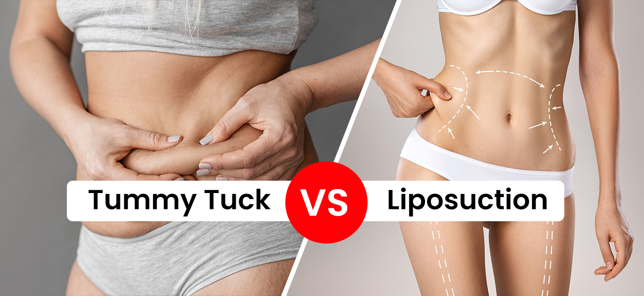 Tummy Tuck vs. Liposuction – Which One is Best for You?