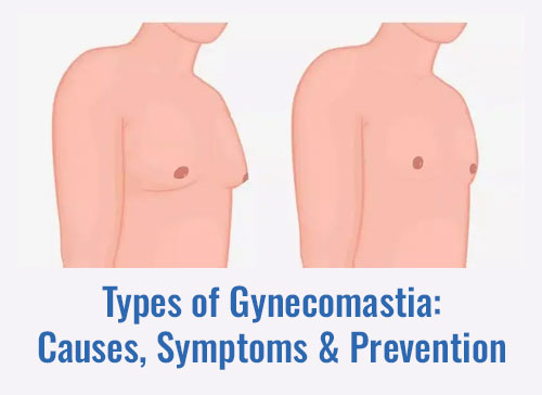 Types of Gynecomastia: Causes, Symptoms & Prevention