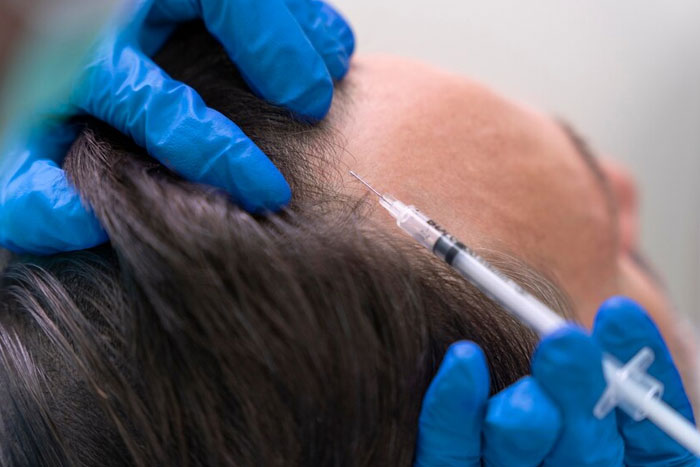Benefits of Hair Transplant