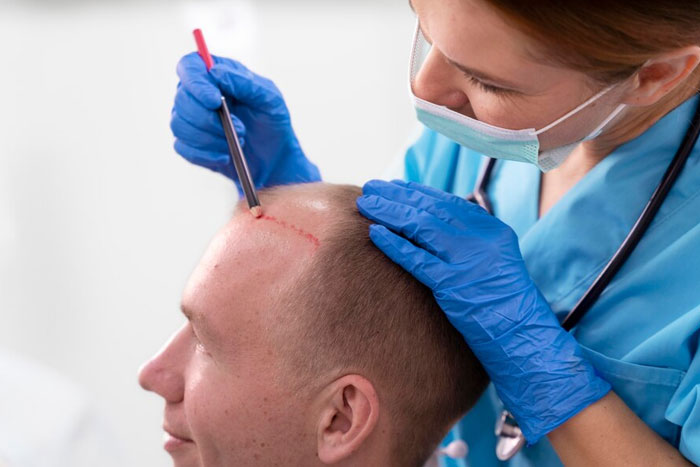 Best Hair Transplant in Greater Kailash, South Delhi