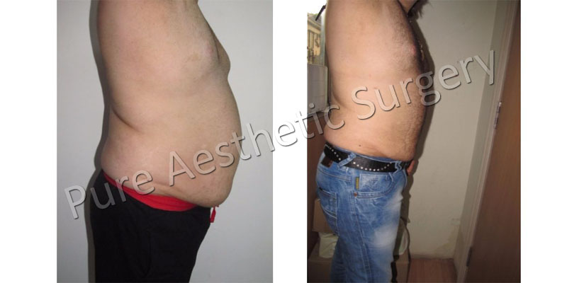 Stomach fat removal surgery in Delhi