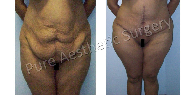 Liposuction surgery price in delhi 
