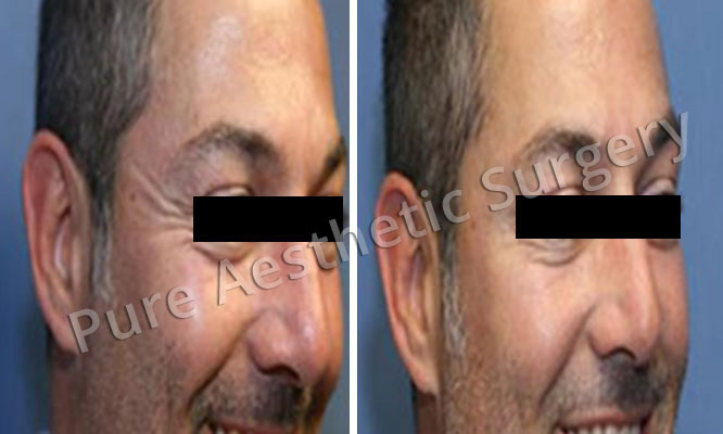 Botox Surgery In Delhi