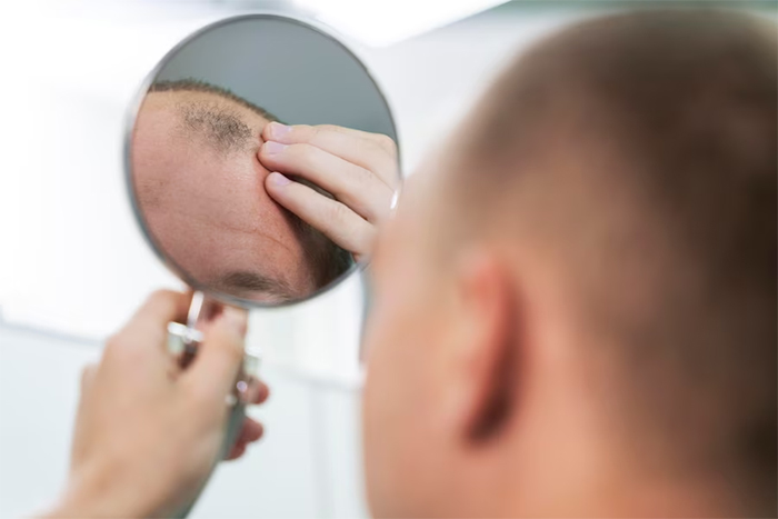 Causes of Hair Loss