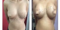 Female Breast Surgery 1