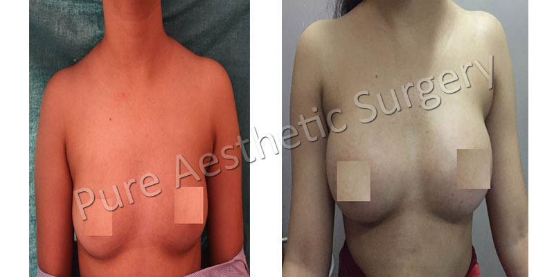 Female Breast Surgery 2