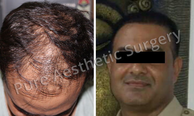 Man Hair Transplant 9