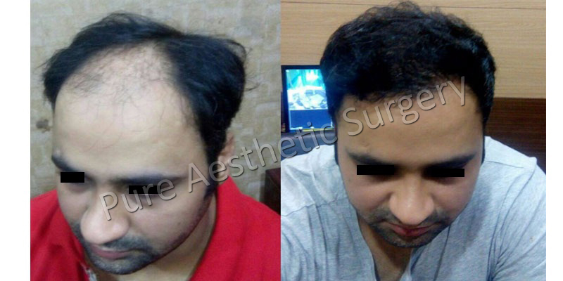Man Hair Transplant 2