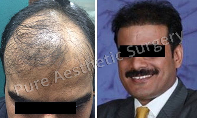 Man Hair Transplant 5