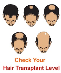 Check your Hair Transsplant Level