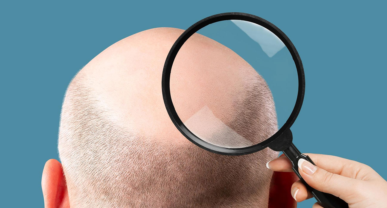 How to Choose the Right Hair Loss Treatment