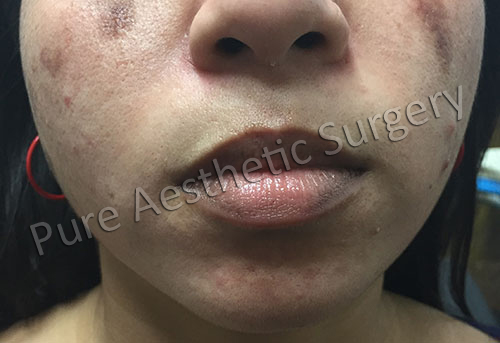Lip Augmentation Surgery 1