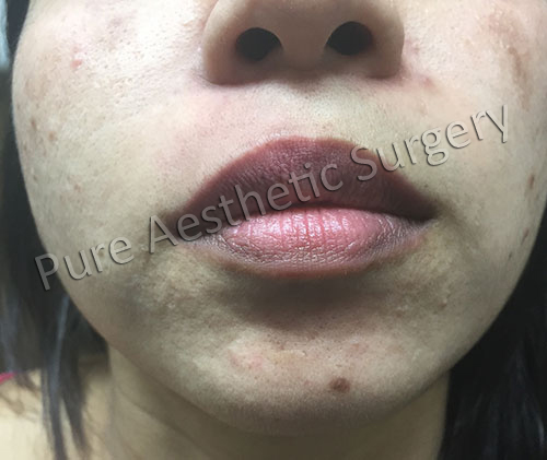 Lip Augmentation Surgery 2