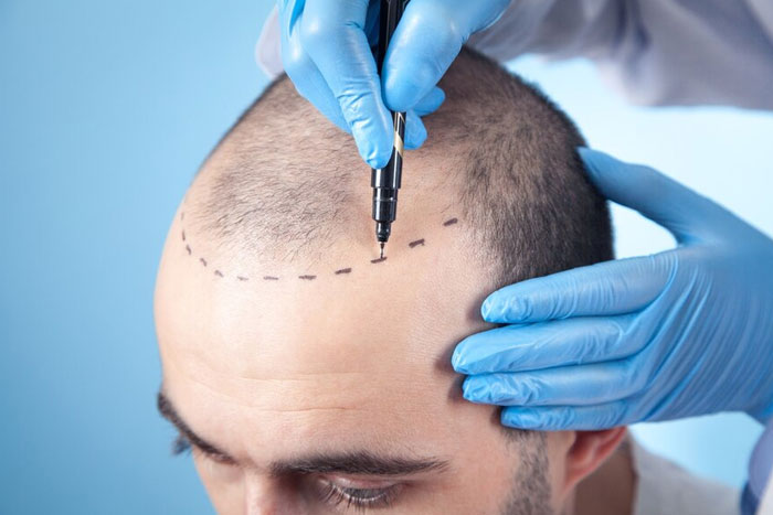 Resplendent Cosmetics - The Best Hair Transplant Clinic in Greater Kailash