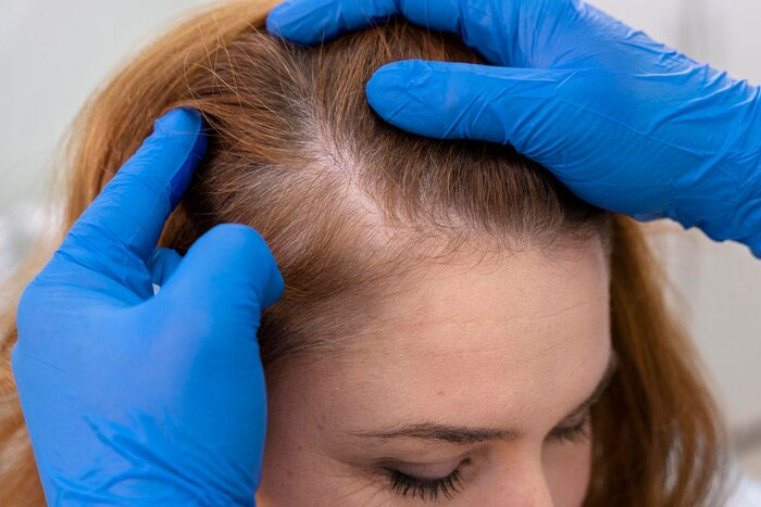 Treatment Options of Hair Loss