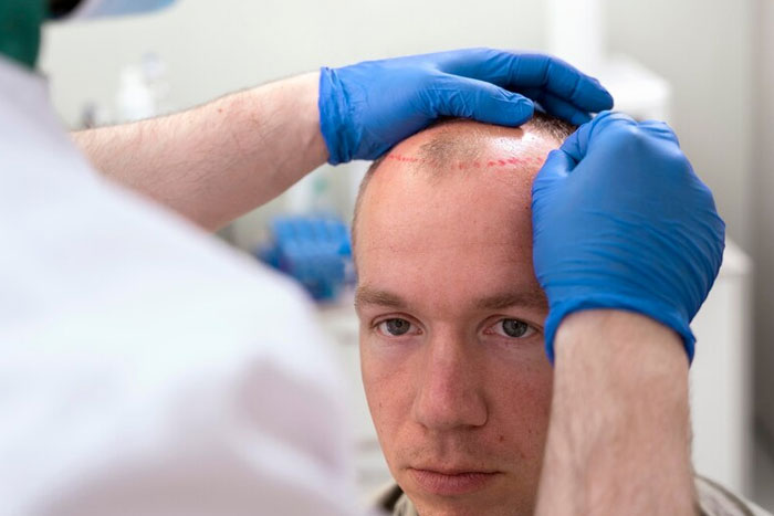 What is Hair Transplant?